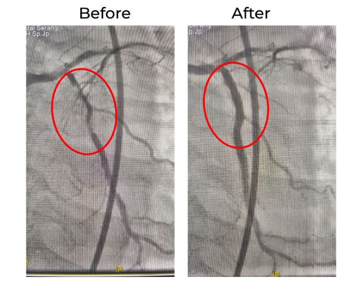 Tim dokter Bethsaida Hospital Serang melakukan prosedur rotablator untuk membuka penyumbatan pembuluh darah jantung